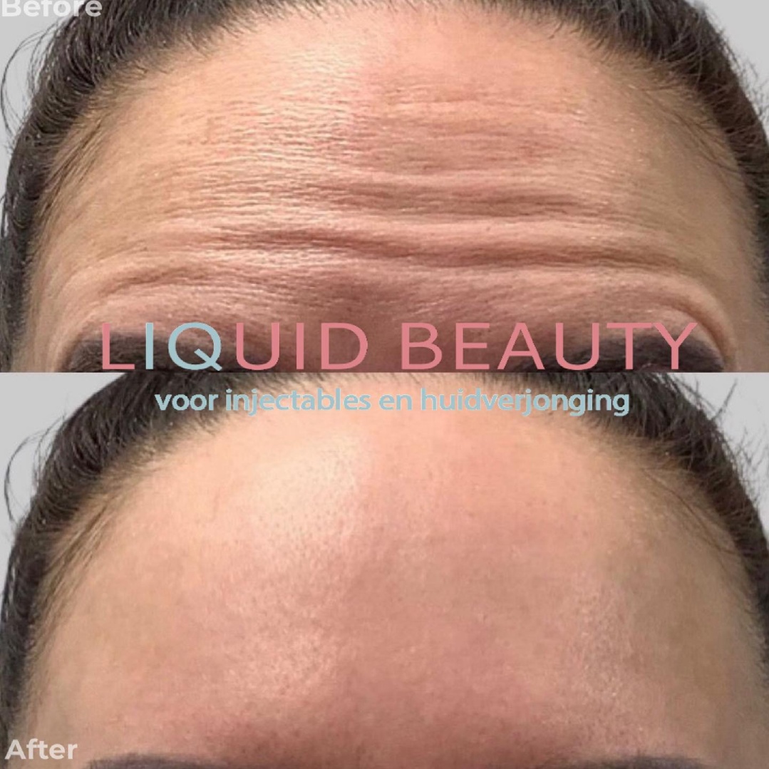 Behandeling met botox